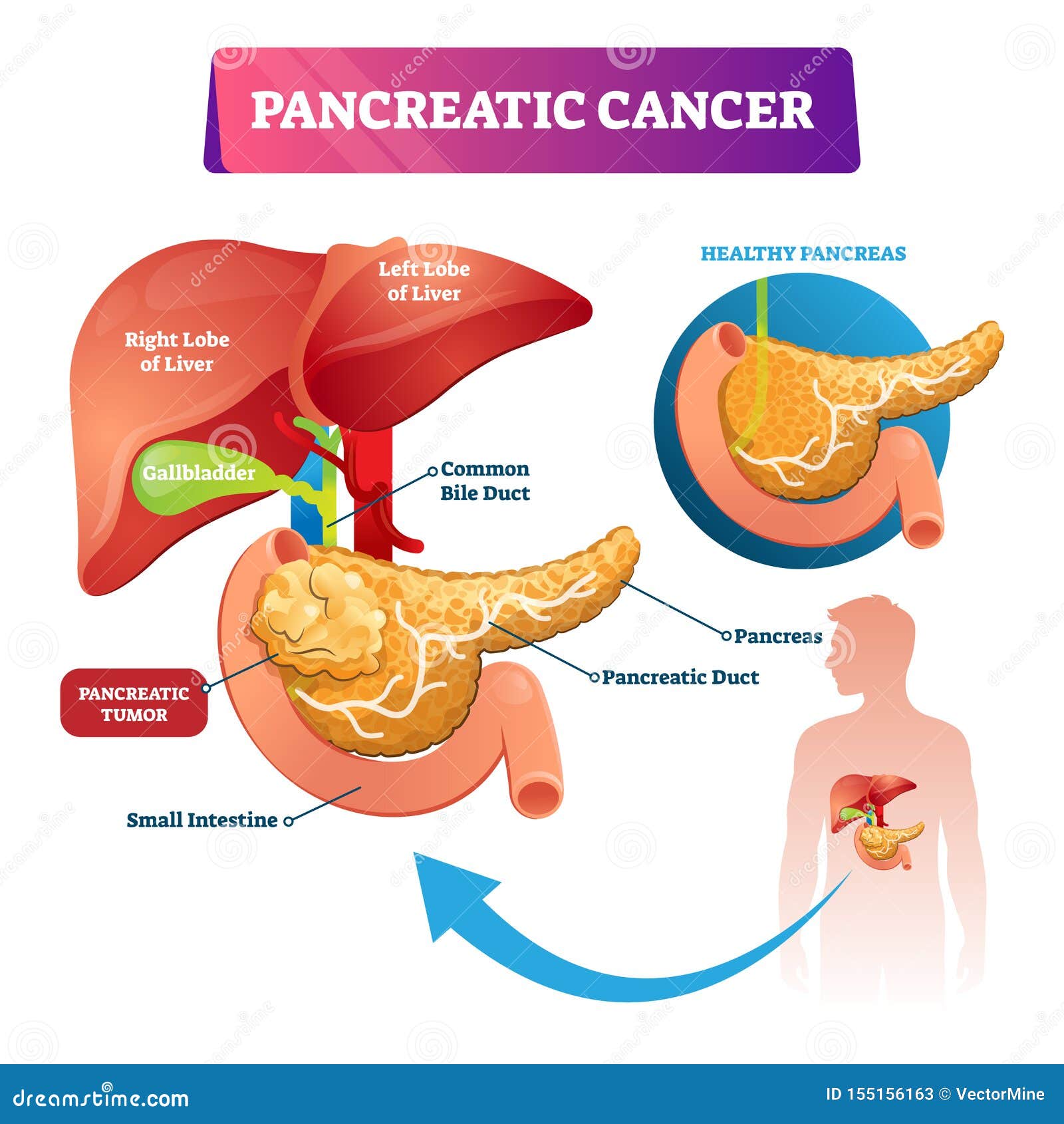 pancreatic cancer  . labeled ill stomach oncology disease