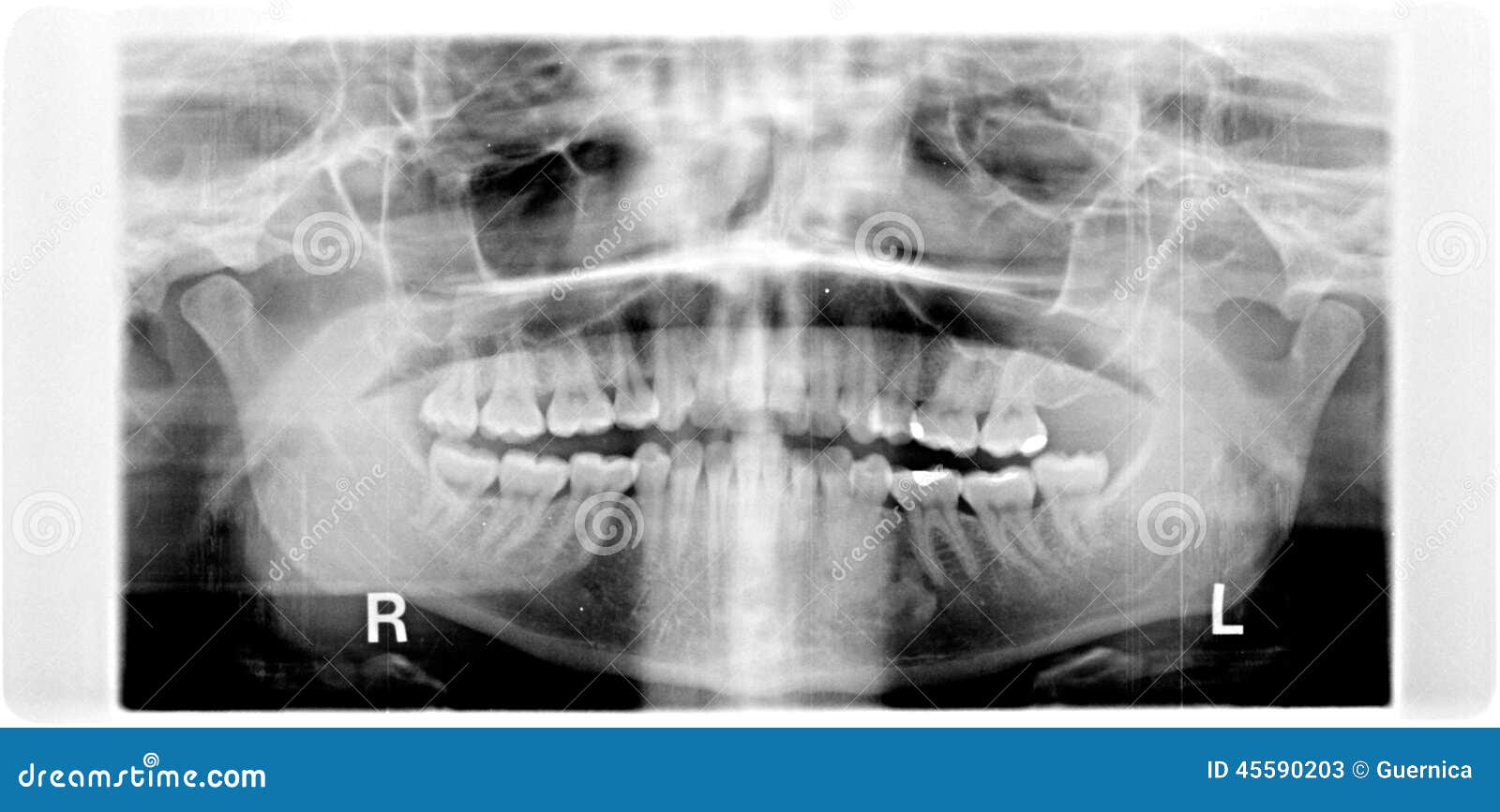 panorama of damaged jaw erosion of the joint tmj