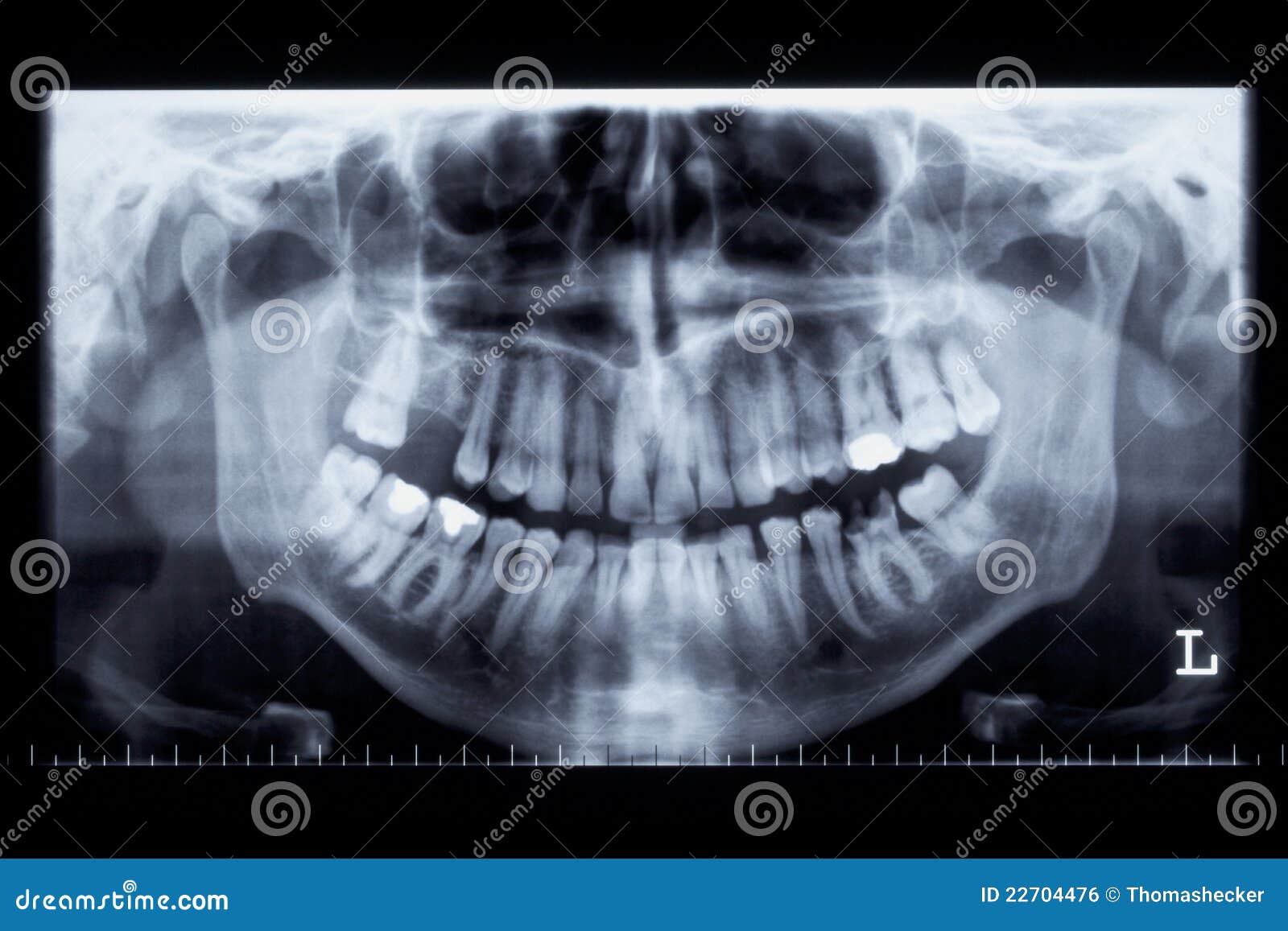 Panorama X-ray Image Of A Human Jaw Royalty Free Stock Image - Image