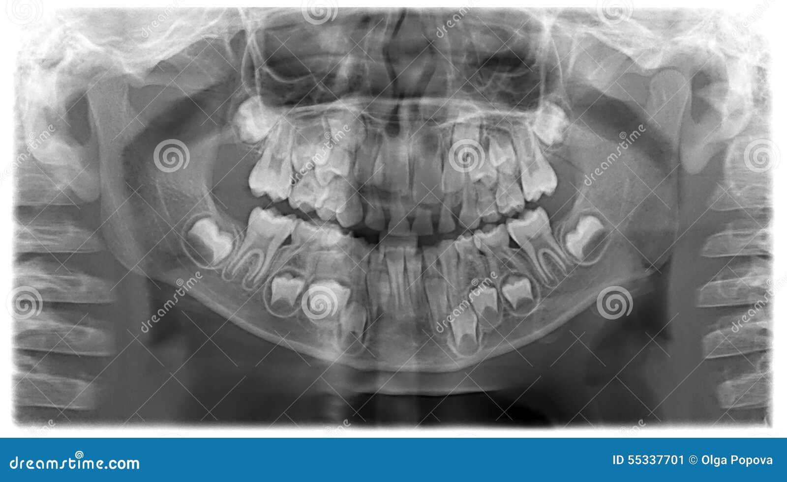 Panoramic Dental XRay of Child 7 Years Stock Image Image of heal