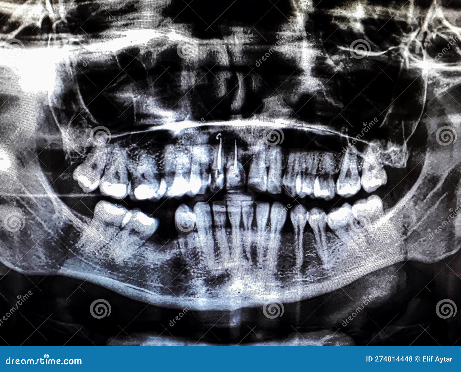 Panoramic Dental Tooth Xray. Radiography for Dental Structures
