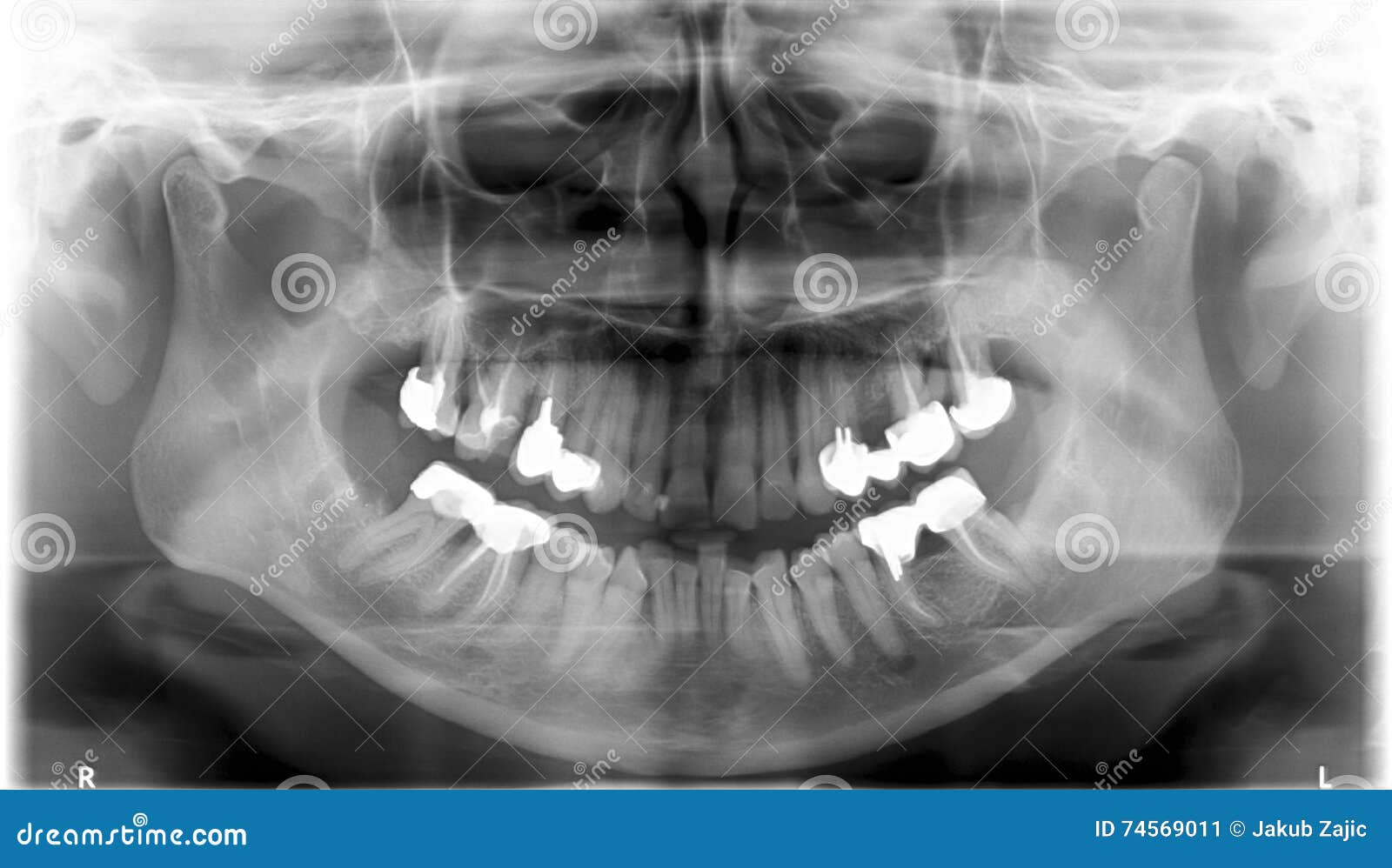 Panoramic dental Xray stock image. Image of science, disease 74569011