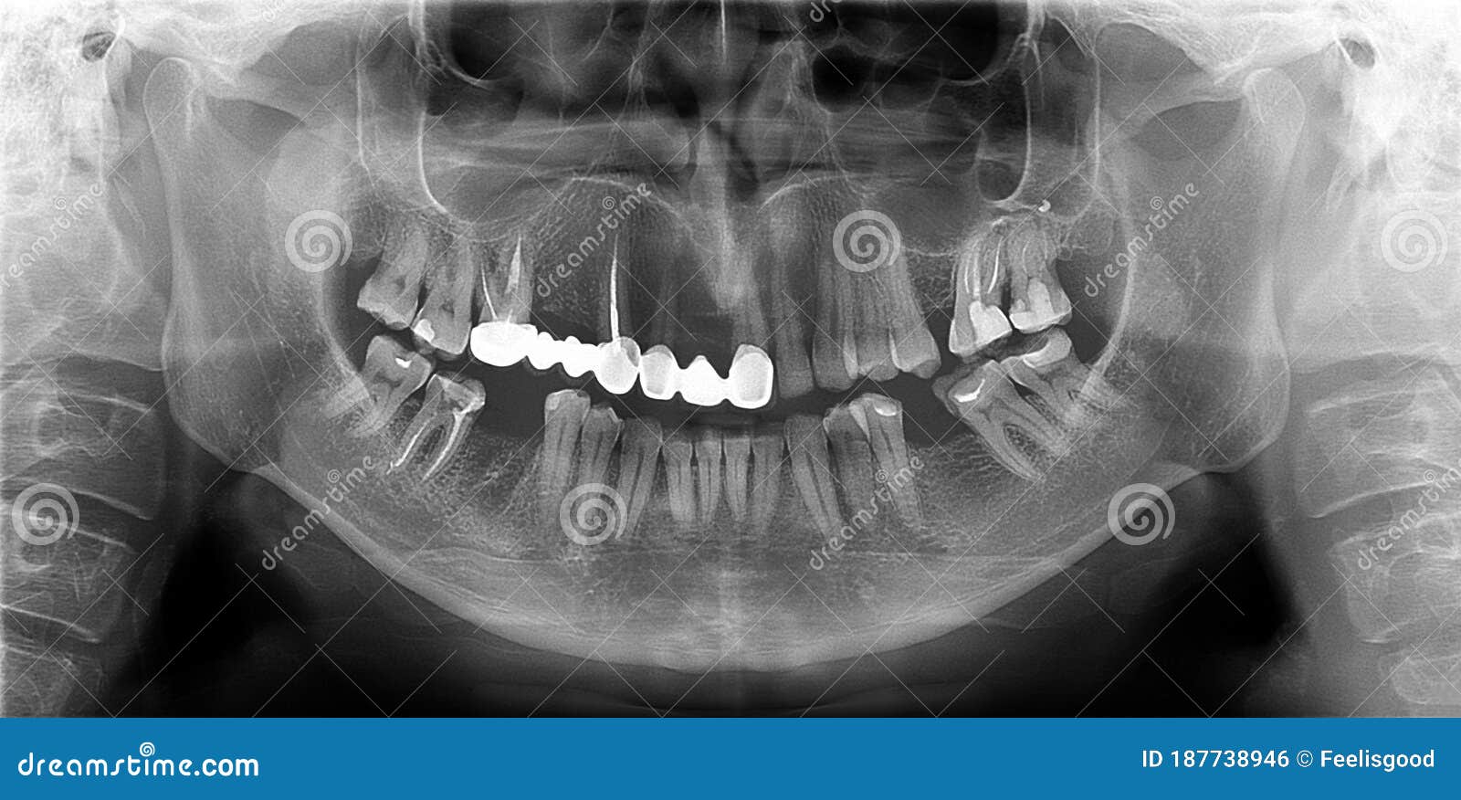 panoramic radiograph is a panoramic scanning dental x-ray of the maxilla and mandible