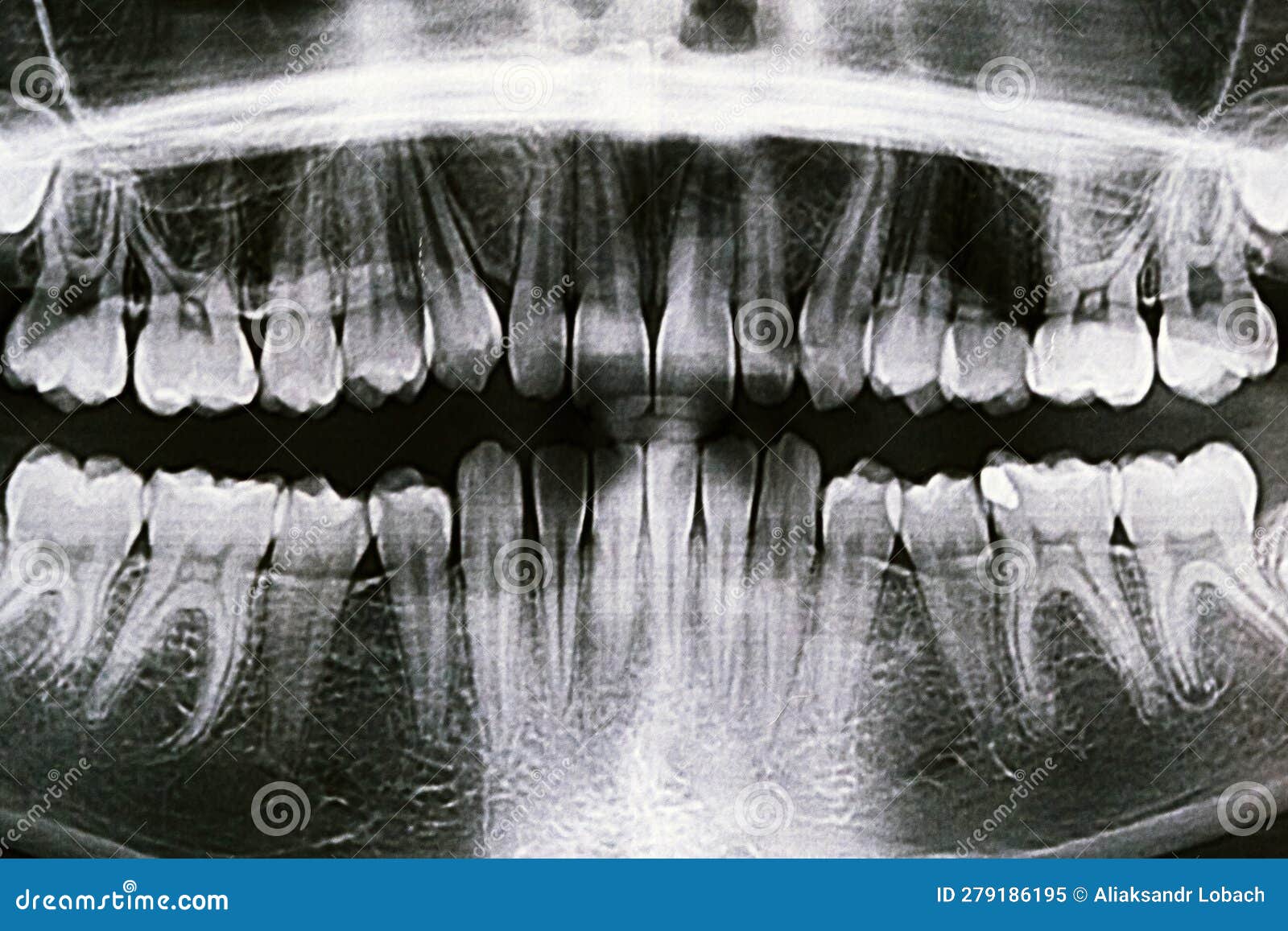 Panoramic Xray of the Jaw. Xray of the Teeth of a 12yearold Girl