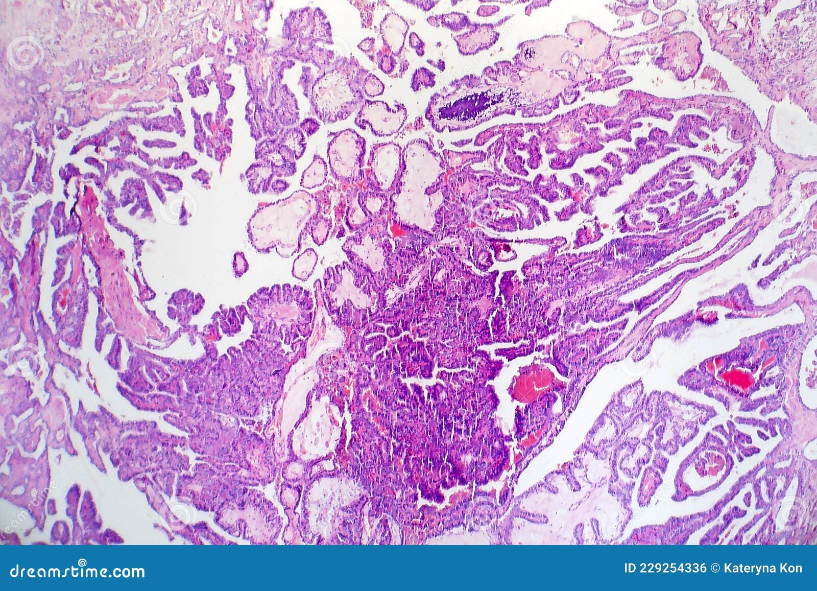 Papillary Thyroid Cancer, Light Micrograph Stock Photo Image of