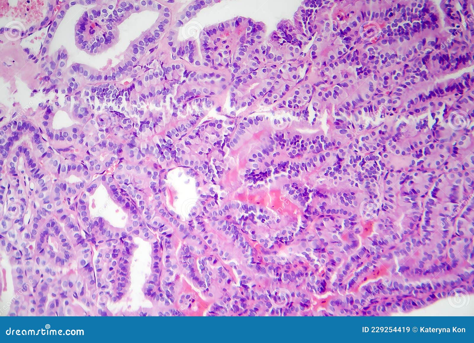 Papillary Thyroid Cancer, Light Micrograph Stock Image Image of