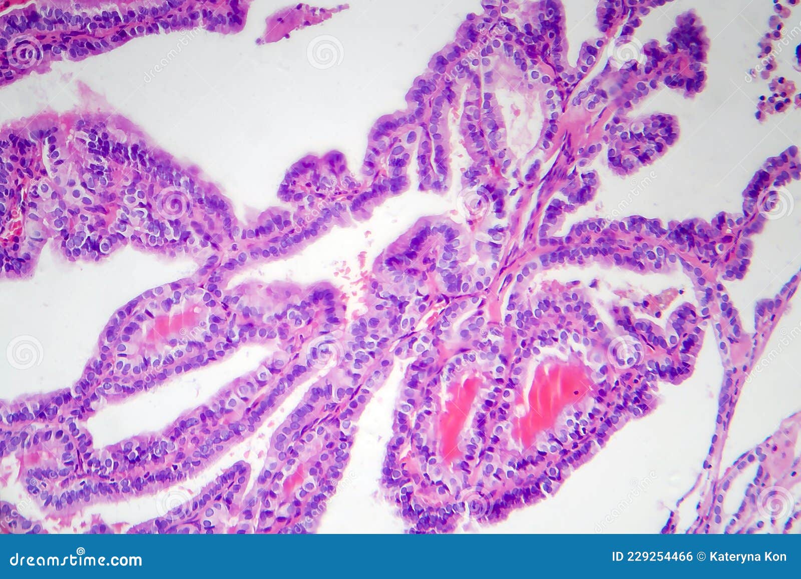 Papillary Thyroid Cancer, Light Micrograph Stock Photo Image of