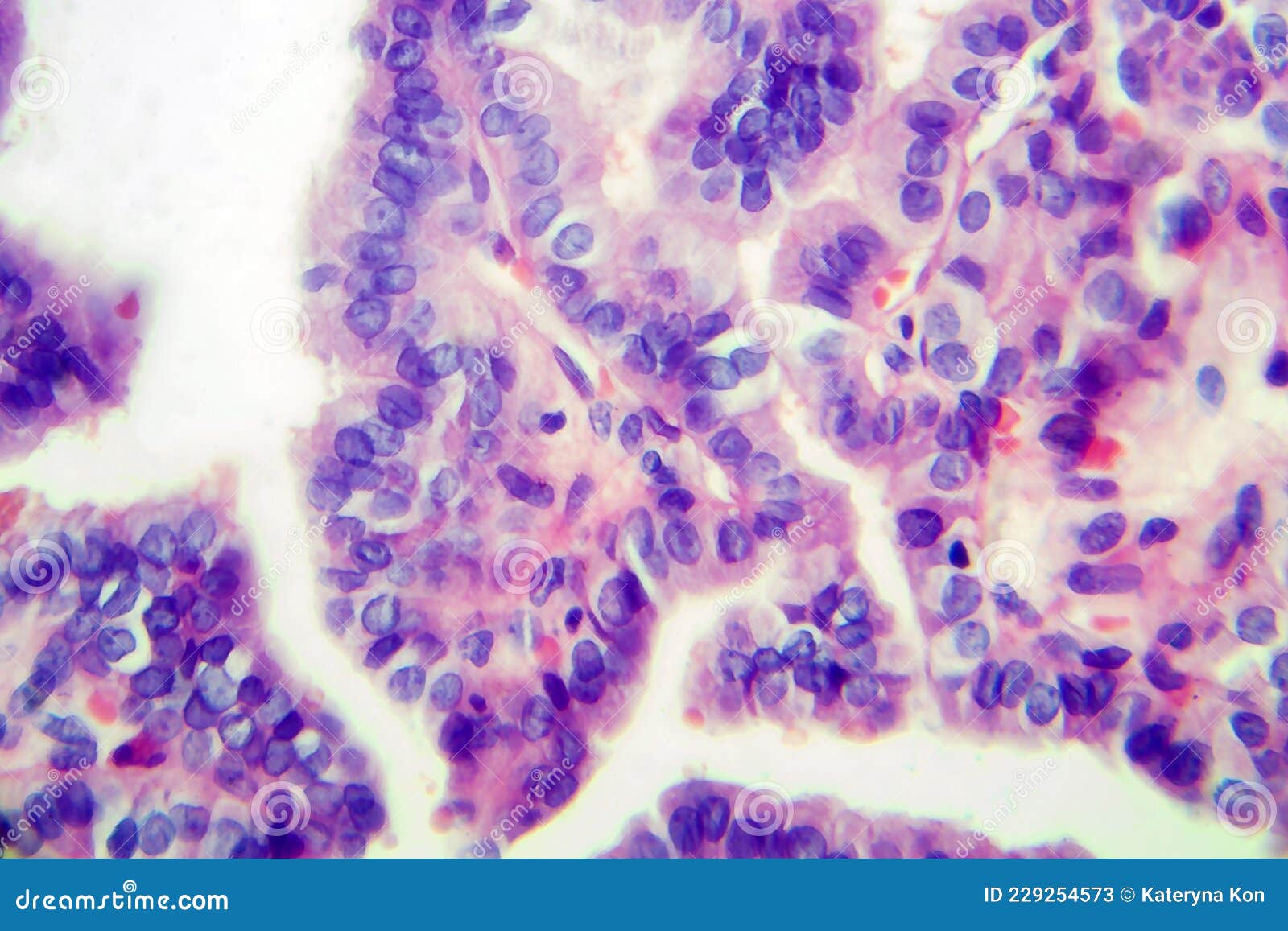 Papillary Thyroid Cancer, Light Micrograph Stock Image Image of
