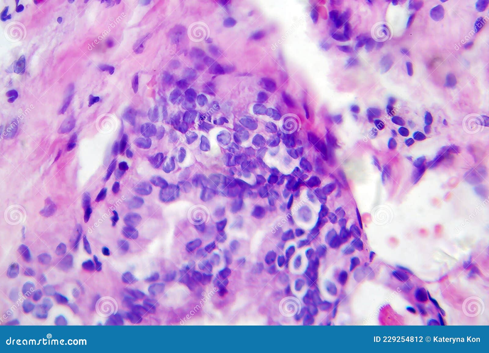 Papillary Thyroid Cancer, Light Micrograph Stock Photo Image of