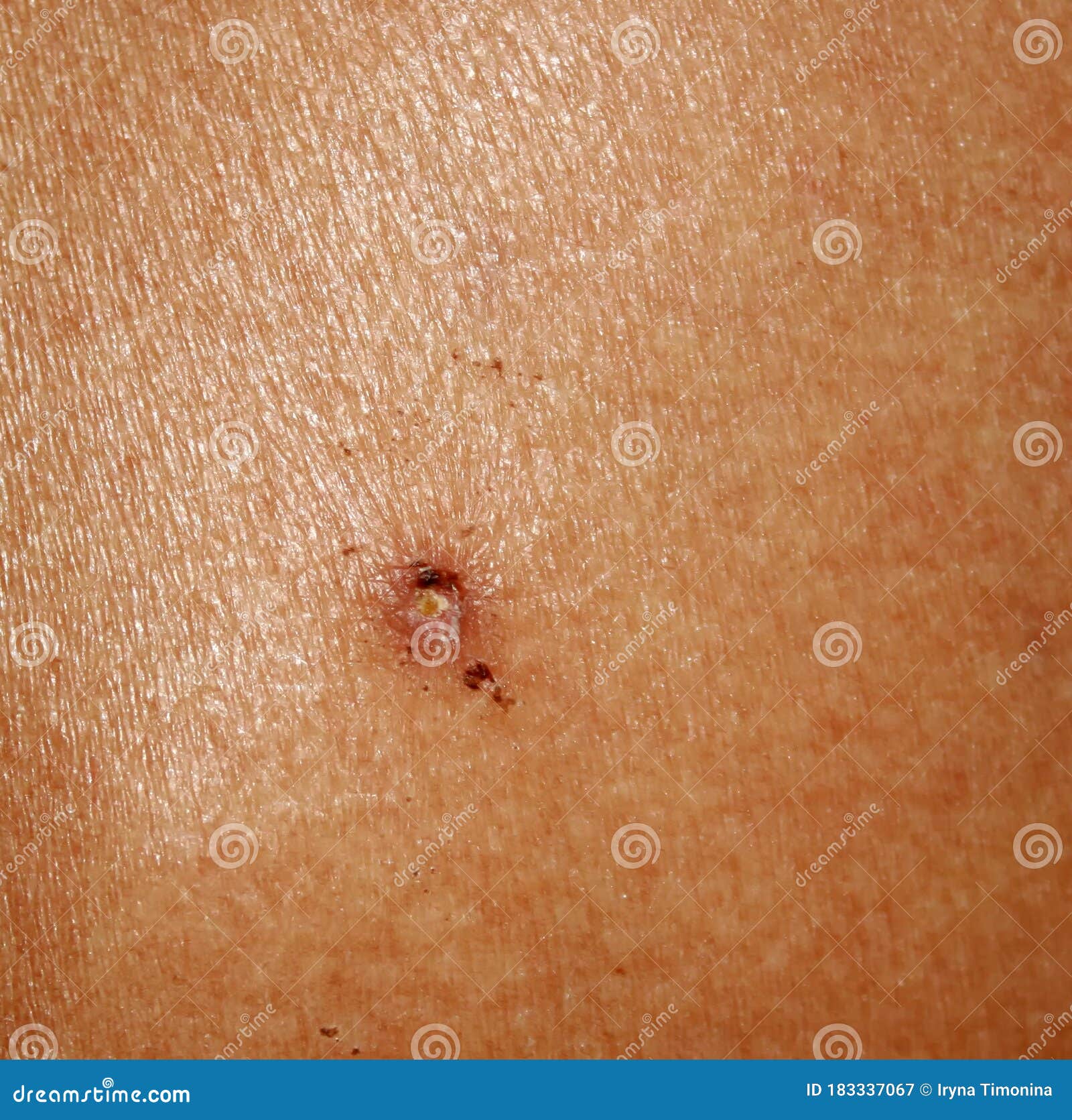 Hpv skin issues
