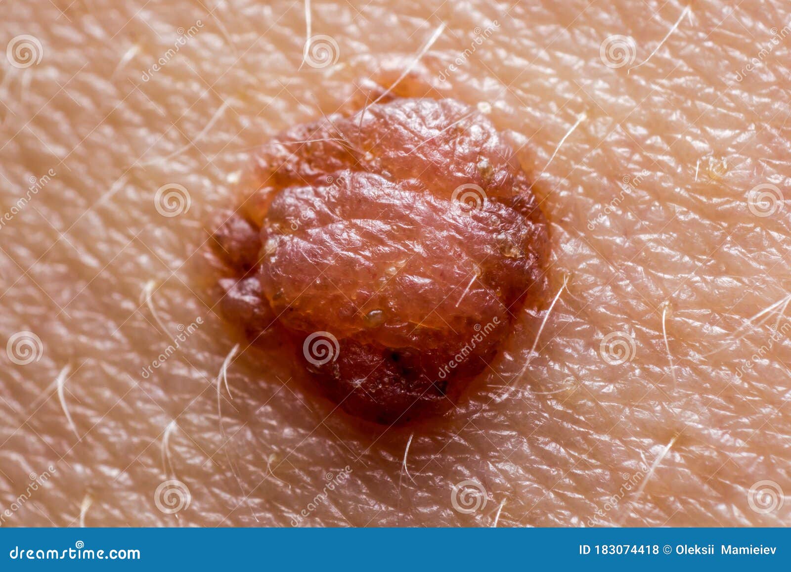 papilloma mole a féreglyuk-rend