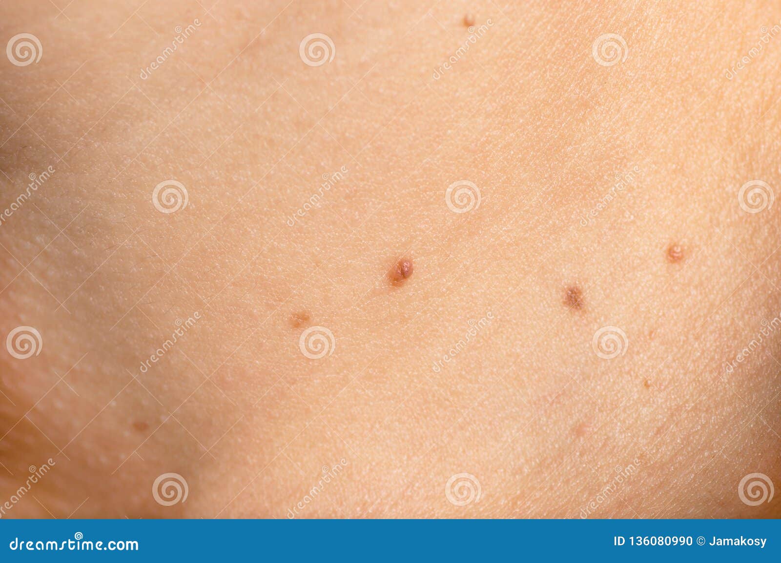 Papillomas mole. Hpv causes moles, Warts and skin cancer