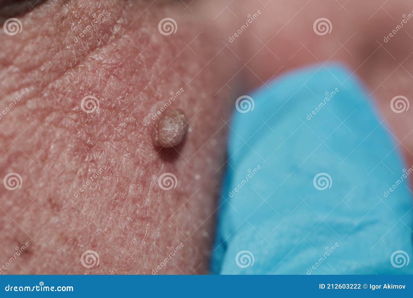 papillomavirus humain sur la peau