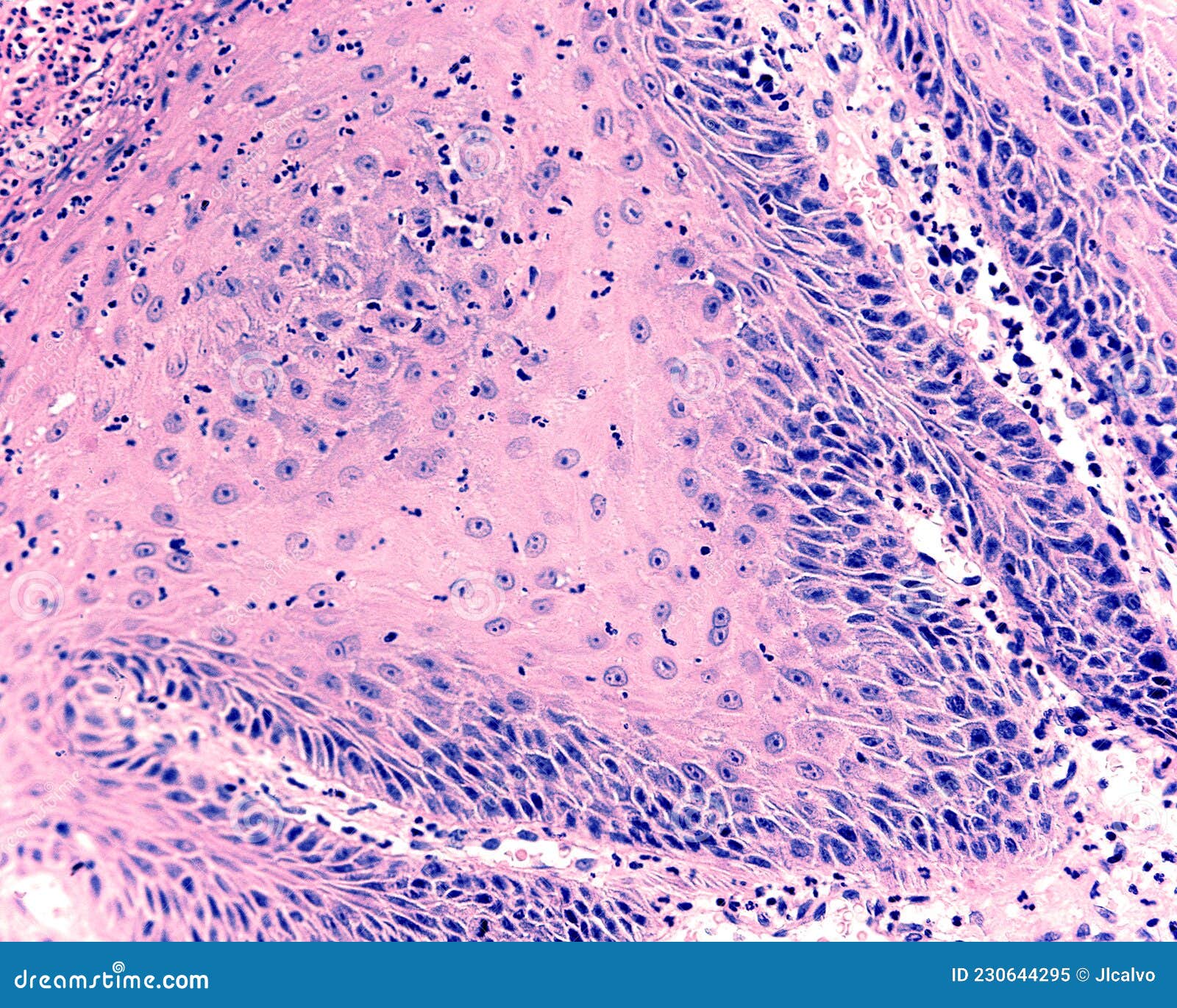 Papilloma del palato. Virus y cavidad oral: Virus del Papiloma Humano abdominal cancer discomfort