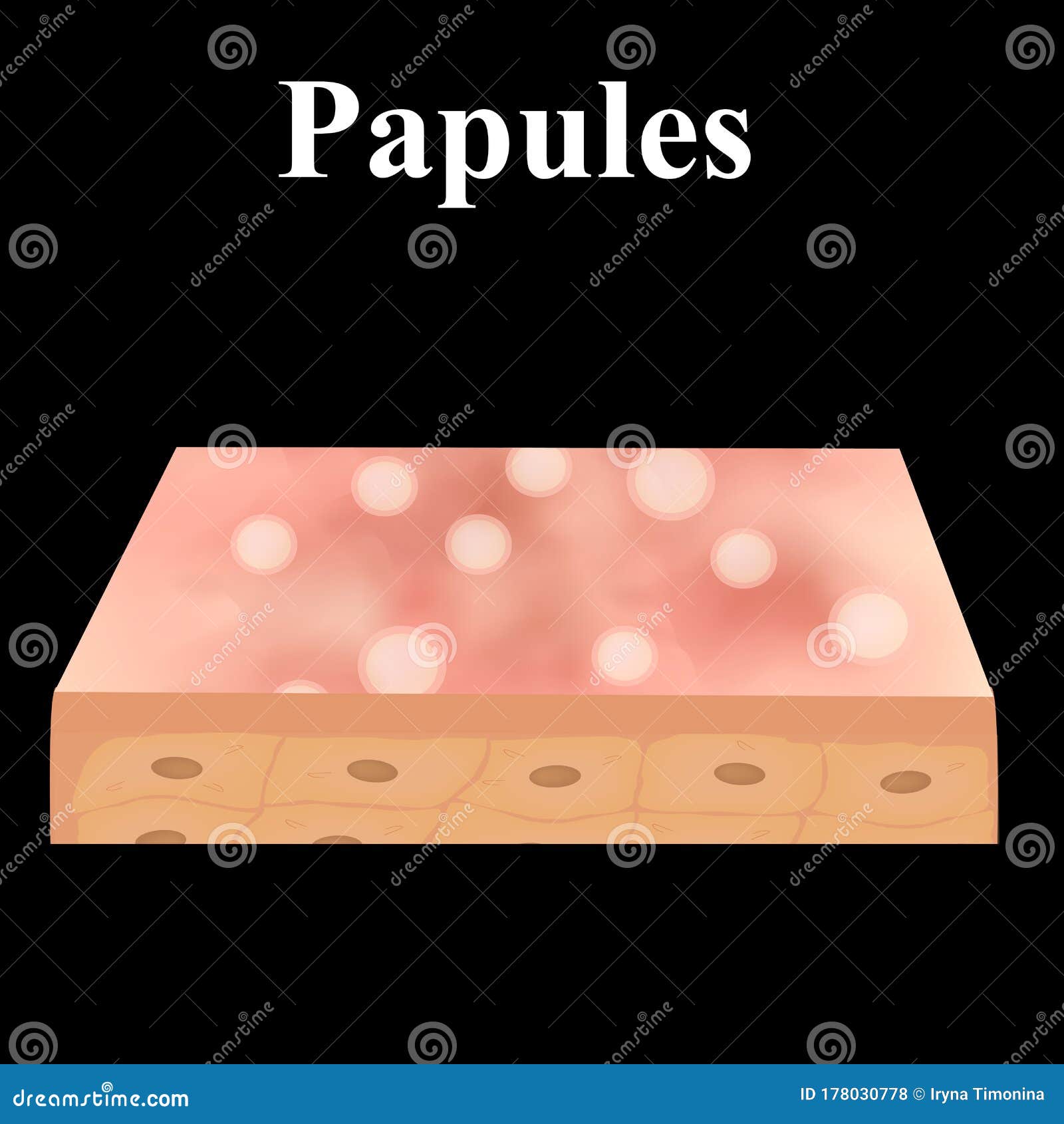 Papules. Acne on the Skin. Dermatological and Cosmetic Diseases on the ...