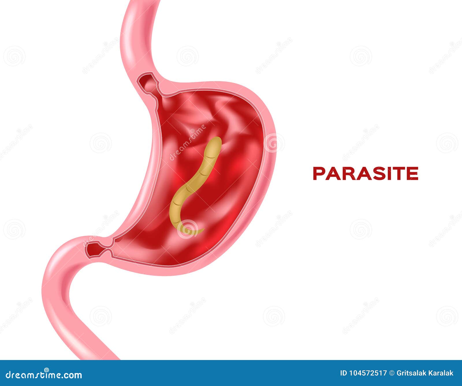 les paraziti de l estomac)