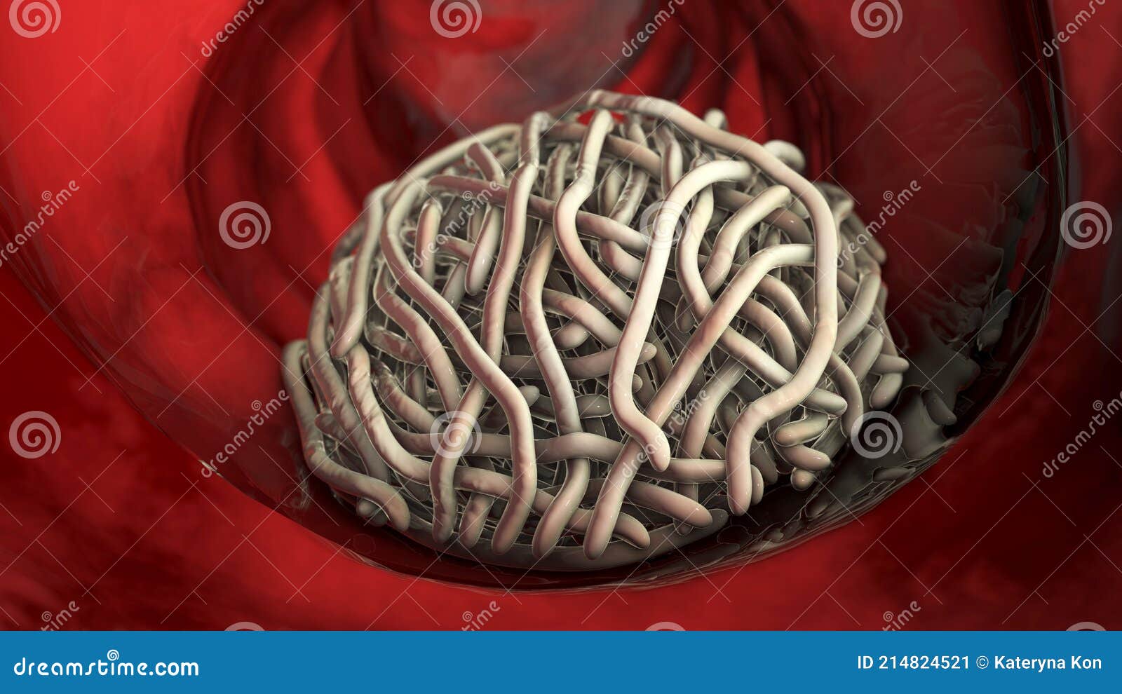Parasitic Worms in the Lumen of Intestine Stock Illustration - Illustration  of closeup, enterobius: 214824521
