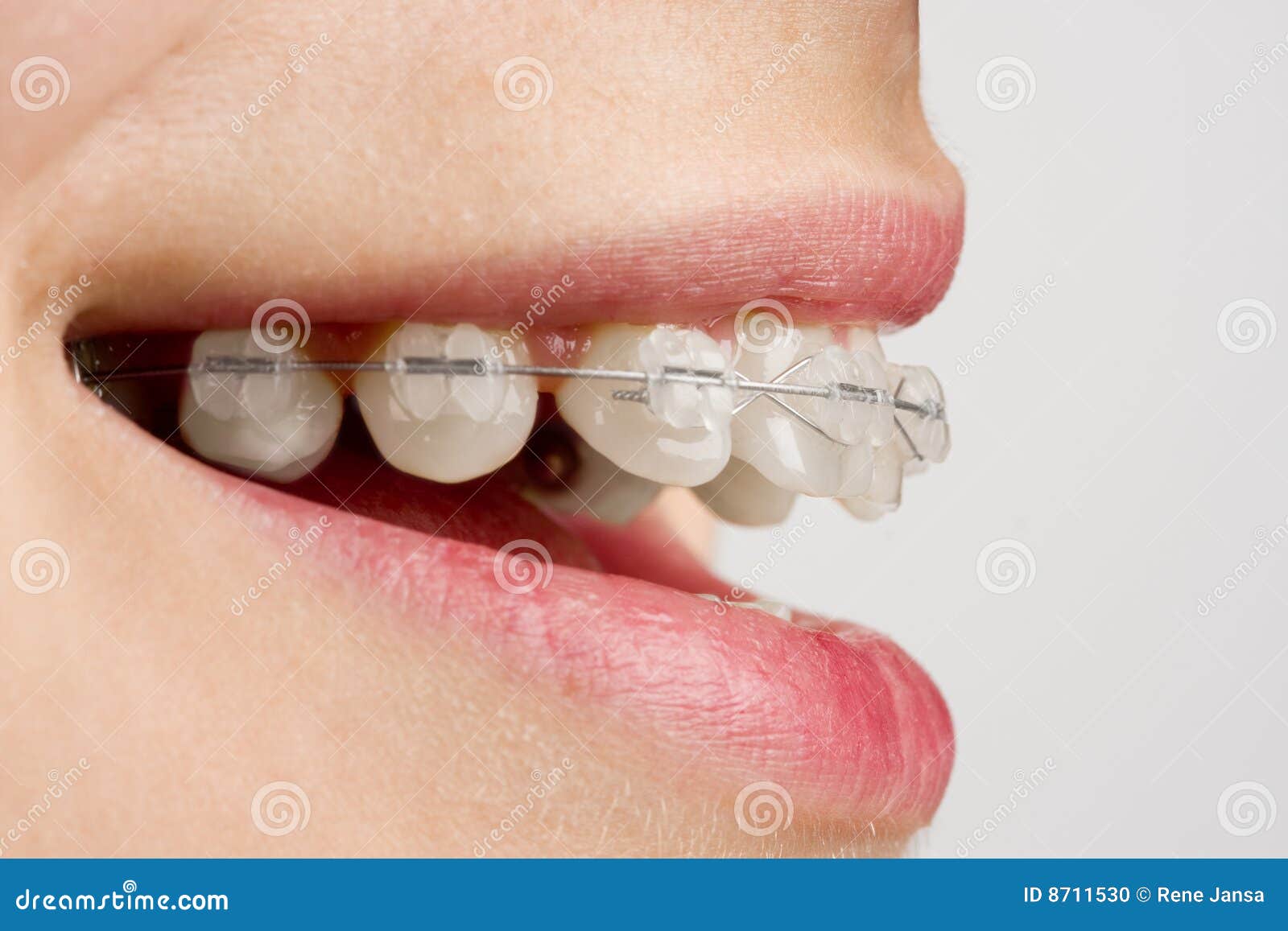 Brackets Mini Roth Bracket Ortodontici Mini Roth MBT 0.022" Con - Foto 6