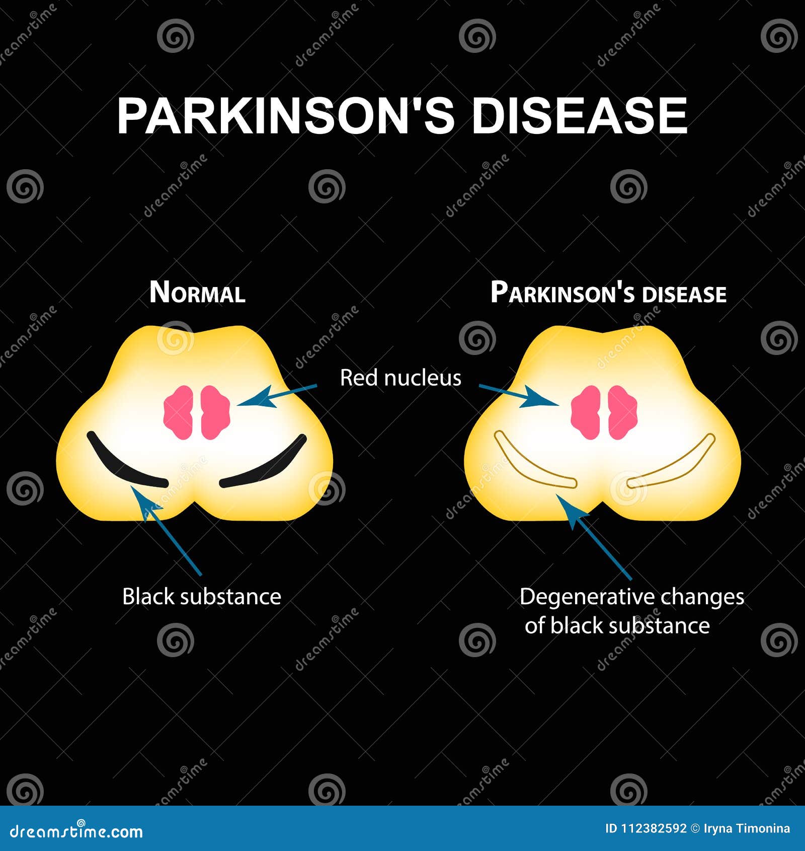 parkinson`s disease. degenerative changes in the brain are a black substance.   on black background.