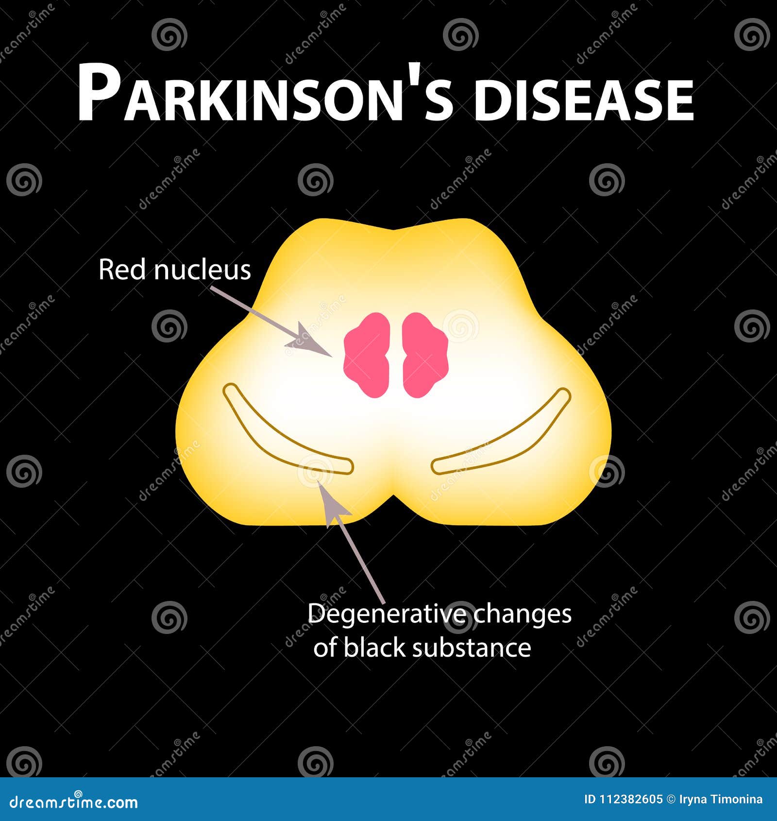 parkinson`s disease. degenerative changes in the brain are a black substance.   on black background.