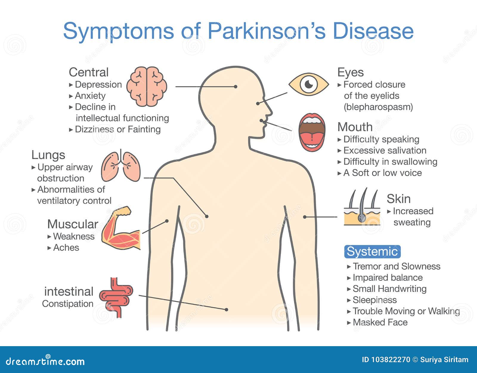 Parkinson` S Krankheitssymptomatik Vektor Abbildung Illustration von