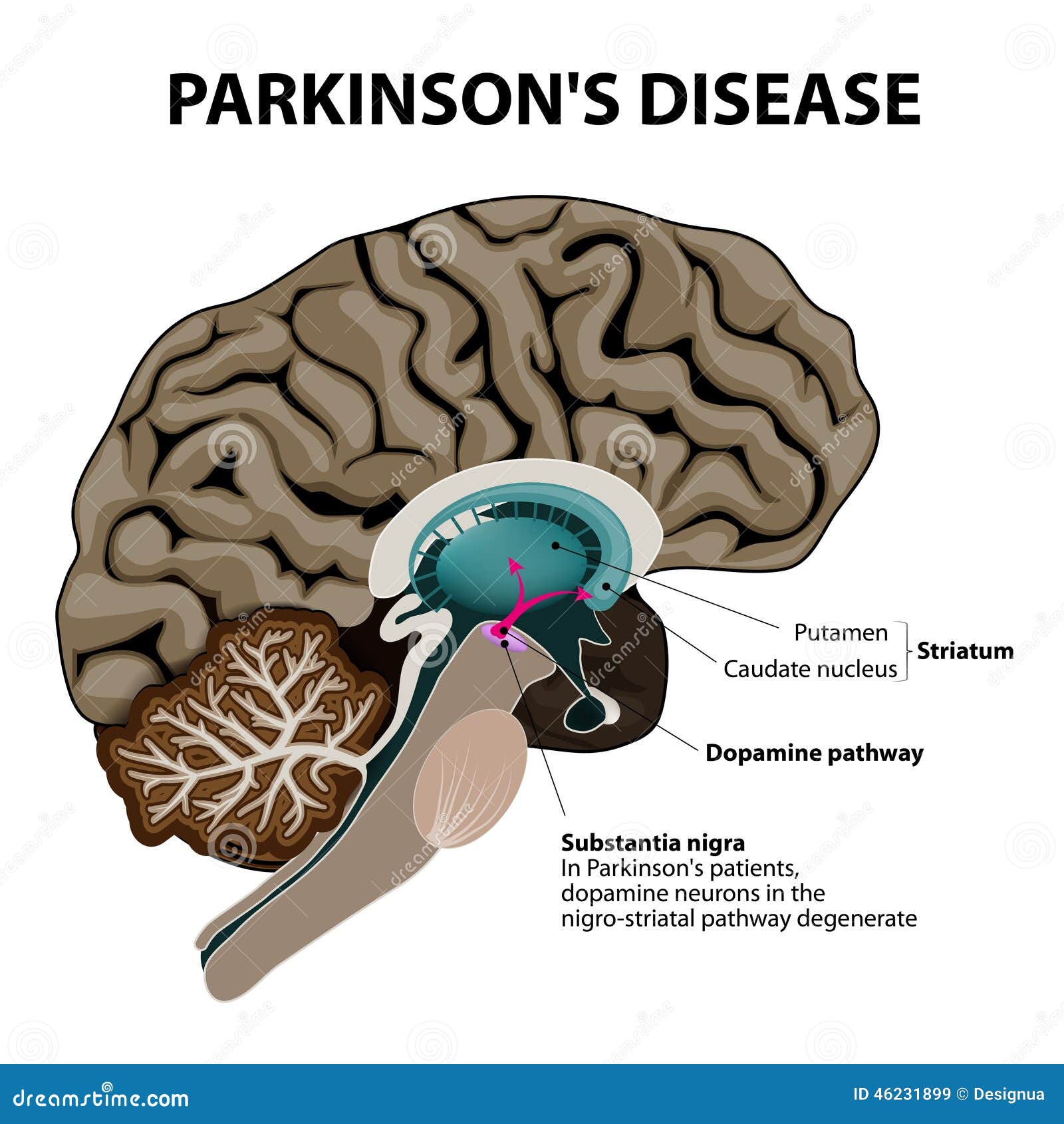 parkinsons disease