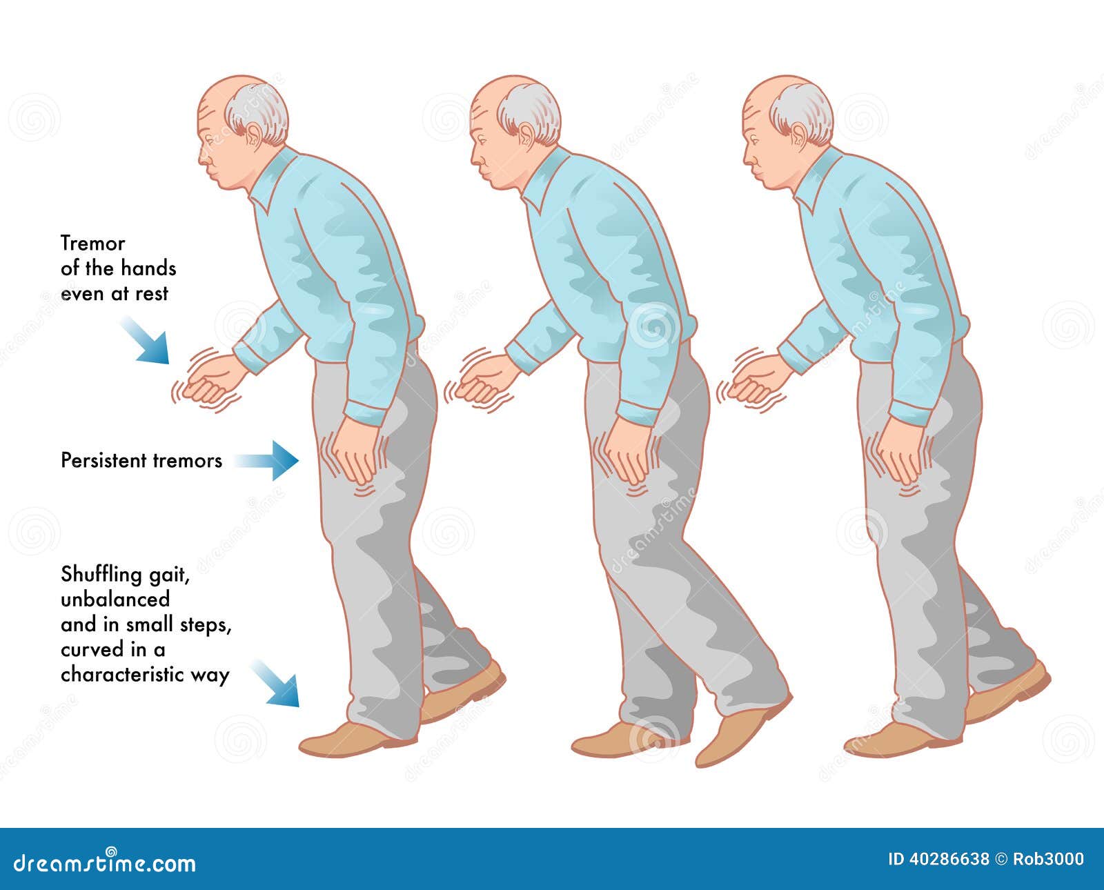 parkinsons disease