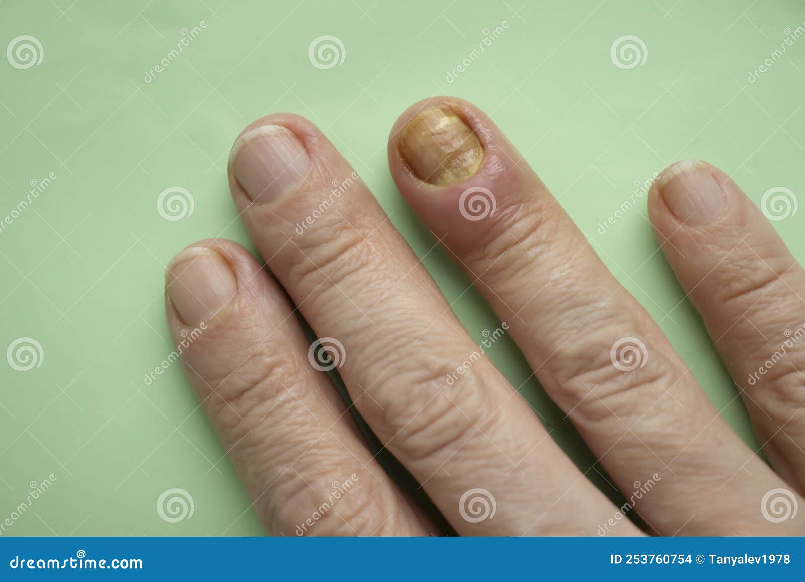 paronychia disease of the fingernail sensation  skin  aches  redness  disease painful  healing  painful  problem