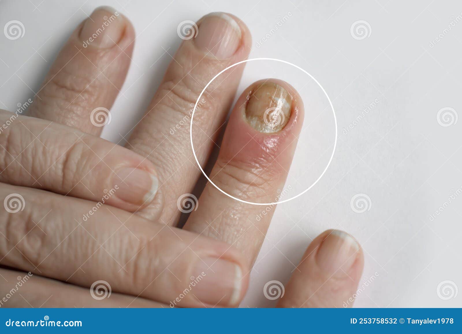 paronychia disease of the fingernail ingrown   painful  healing  painful  problem