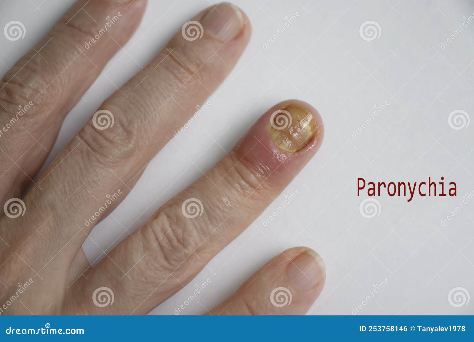 paronychia disease of the fingernail  painful  healing  painful  problem