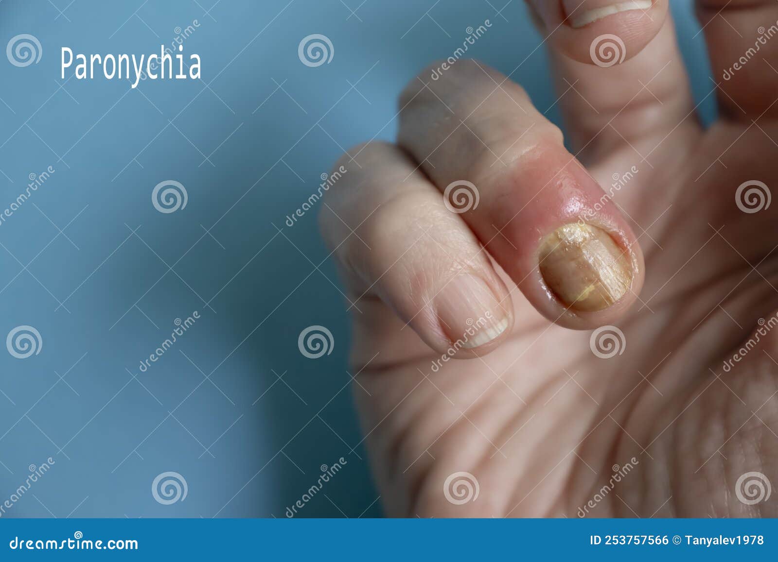 paronychia disease of the fingernail bacteria  painful  problem