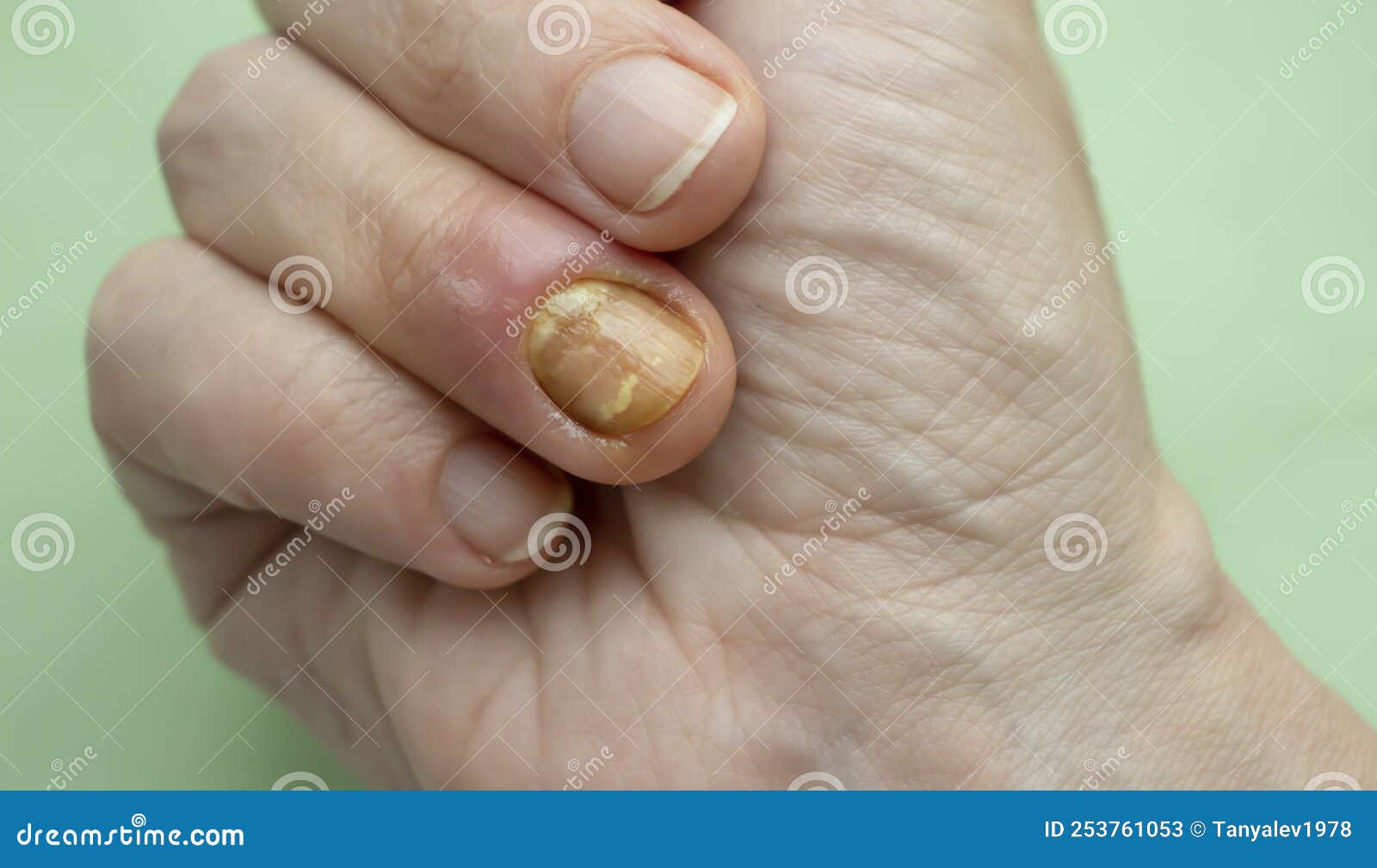 paronychia disease of the fingernail infection skin  aches  redness  disease painful  healing  painful  problem