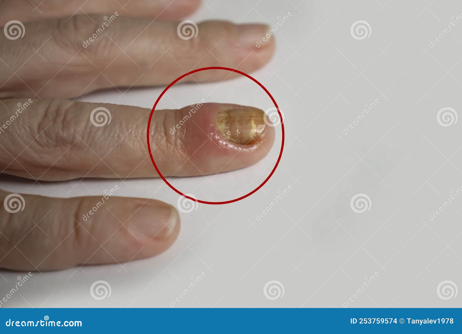 paronychia disease of the fingernail  redness  disease painful  healing  painful  problem