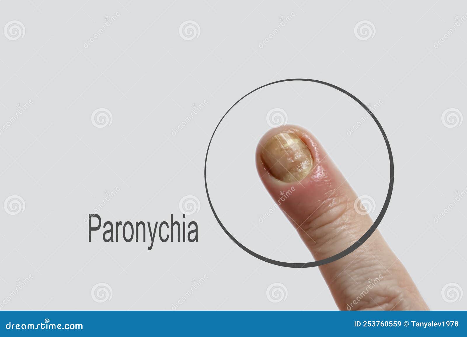 paronychia disease of the fingernail symptom    skin  aches  redness  disease painful  healing  painful  problem