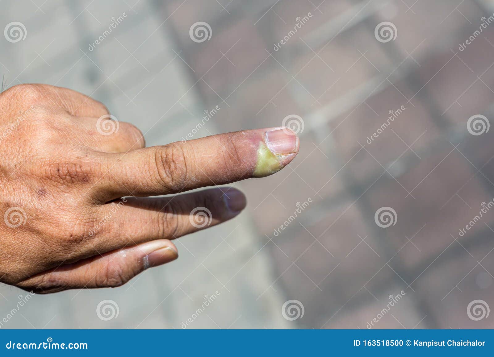 Nail Infection Pus Stock Photos - Free & Royalty-Free Stock Photos from Dreamstime Nail Infection Pus Stock Photos - Free & Royalty-Free Stock Photos from Dreamstime