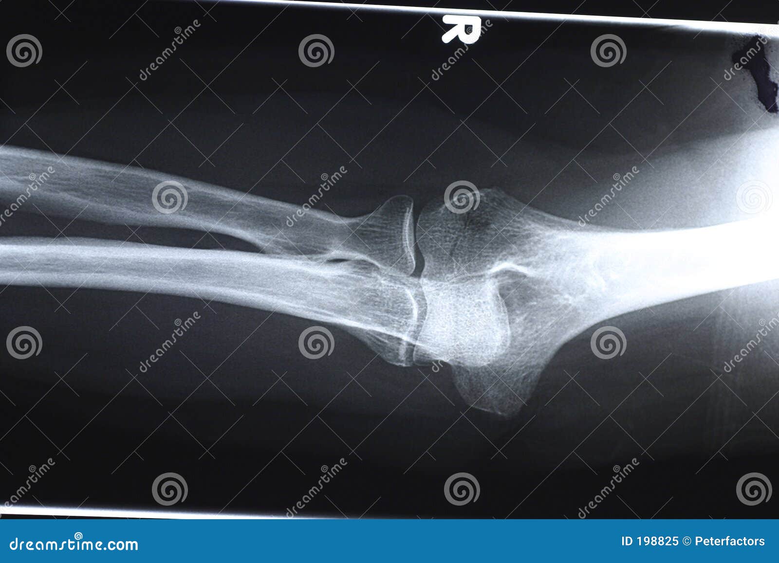 Raio-X/Cotovelo frente imagem de stock. Imagem de esqueleto - 198825, image size:1600x1157