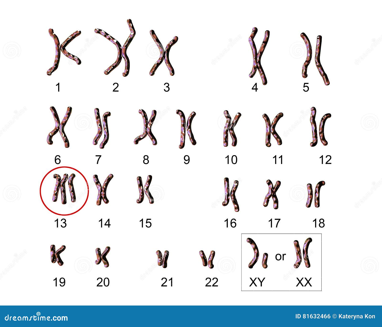 jacobs syndrome karyotype