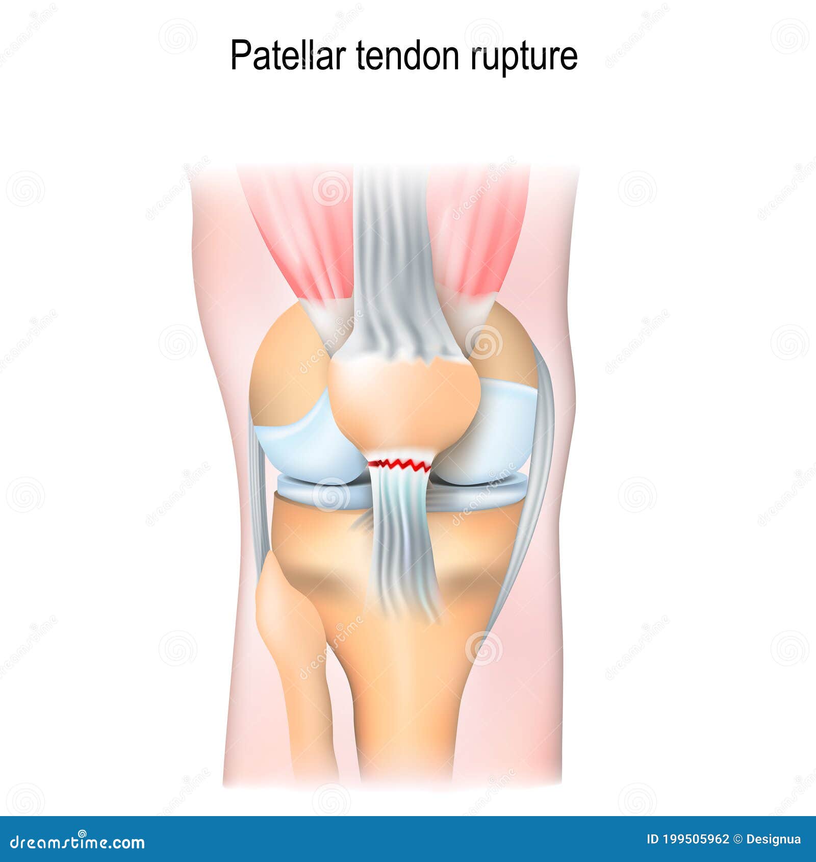 patellar tendon rupture