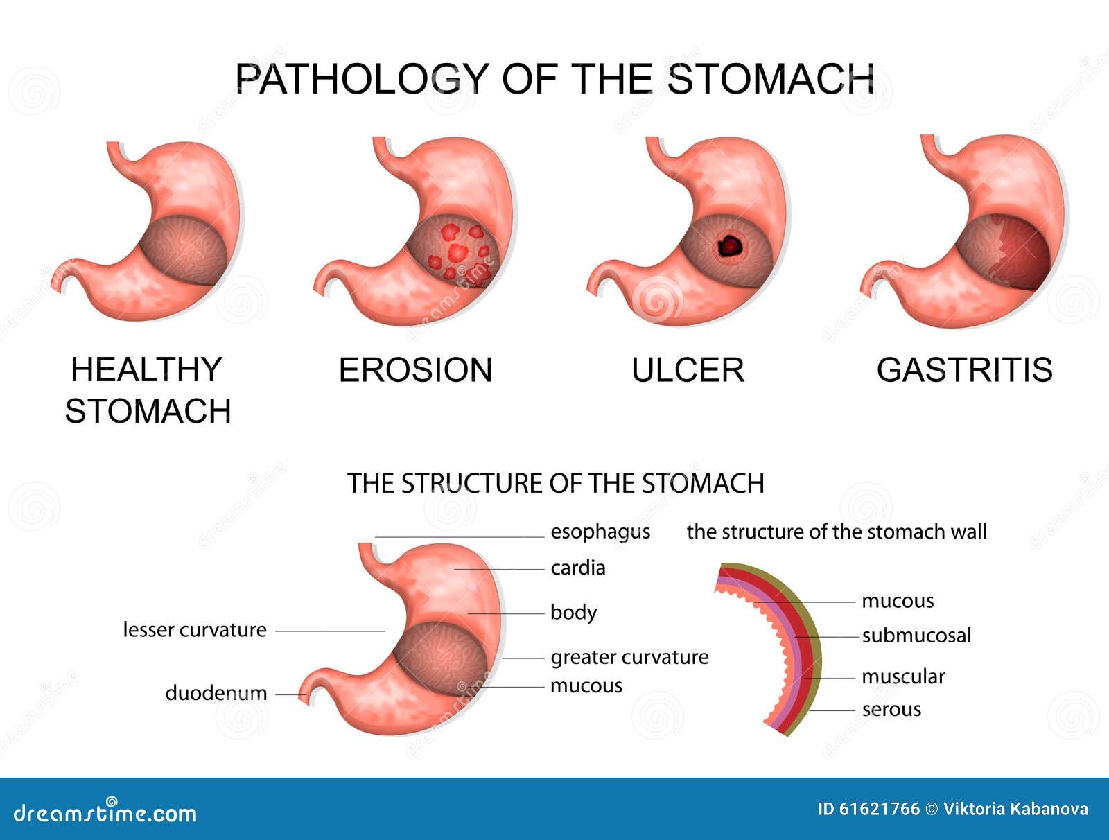 Pathology Of The Stomach Stock Vector Image 61621766