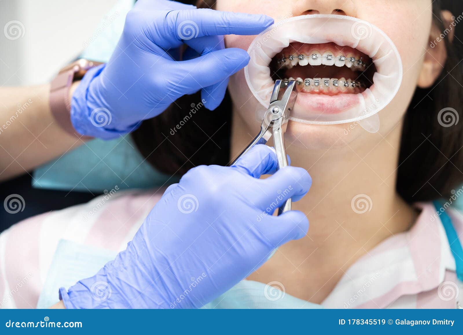 Dentiste Enlever Les Bandes De Caoutchouc Des Accolades Du Patient. Image  stock - Image du brides, émail: 222958585