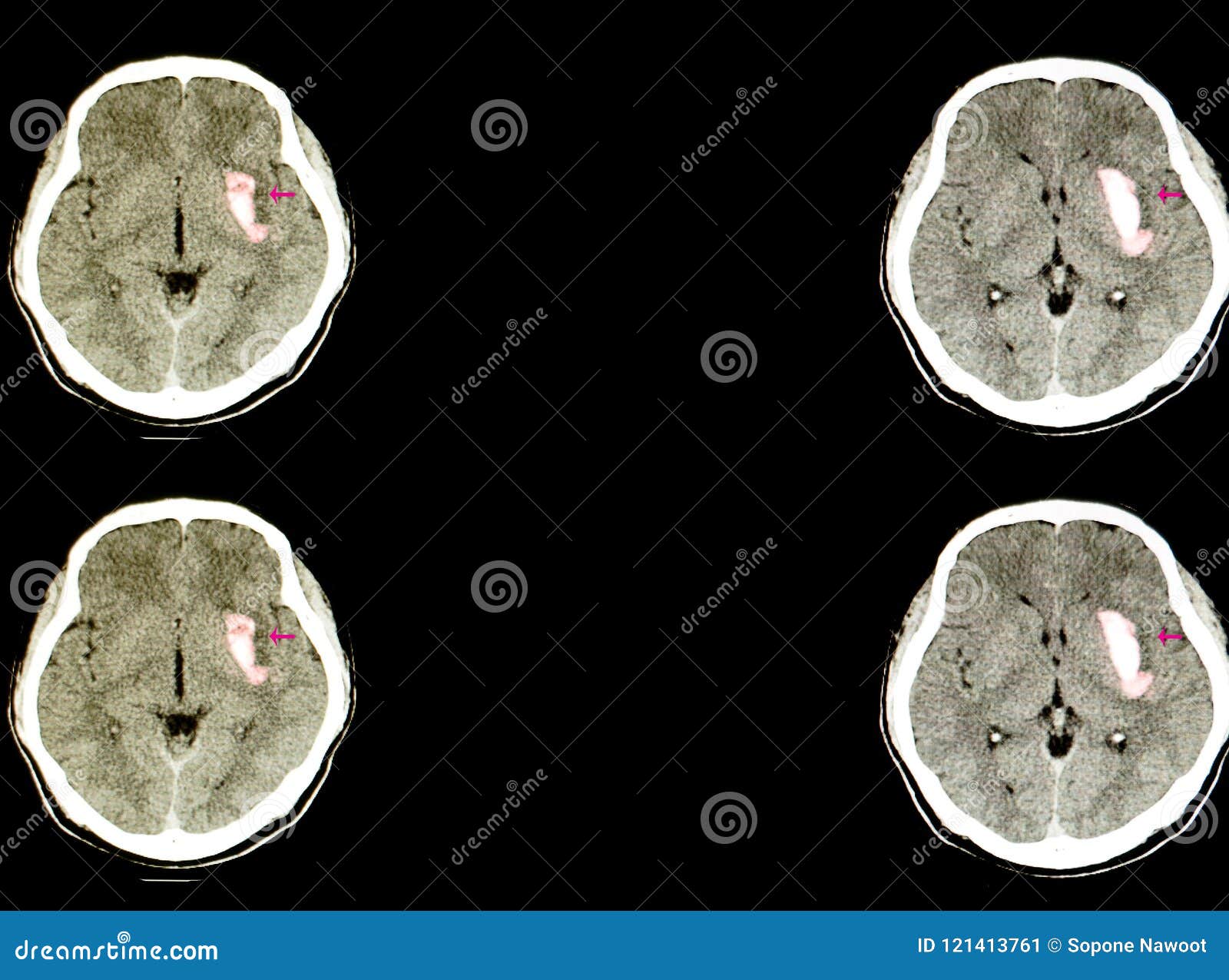 a patient with a large hematoma in the brain
