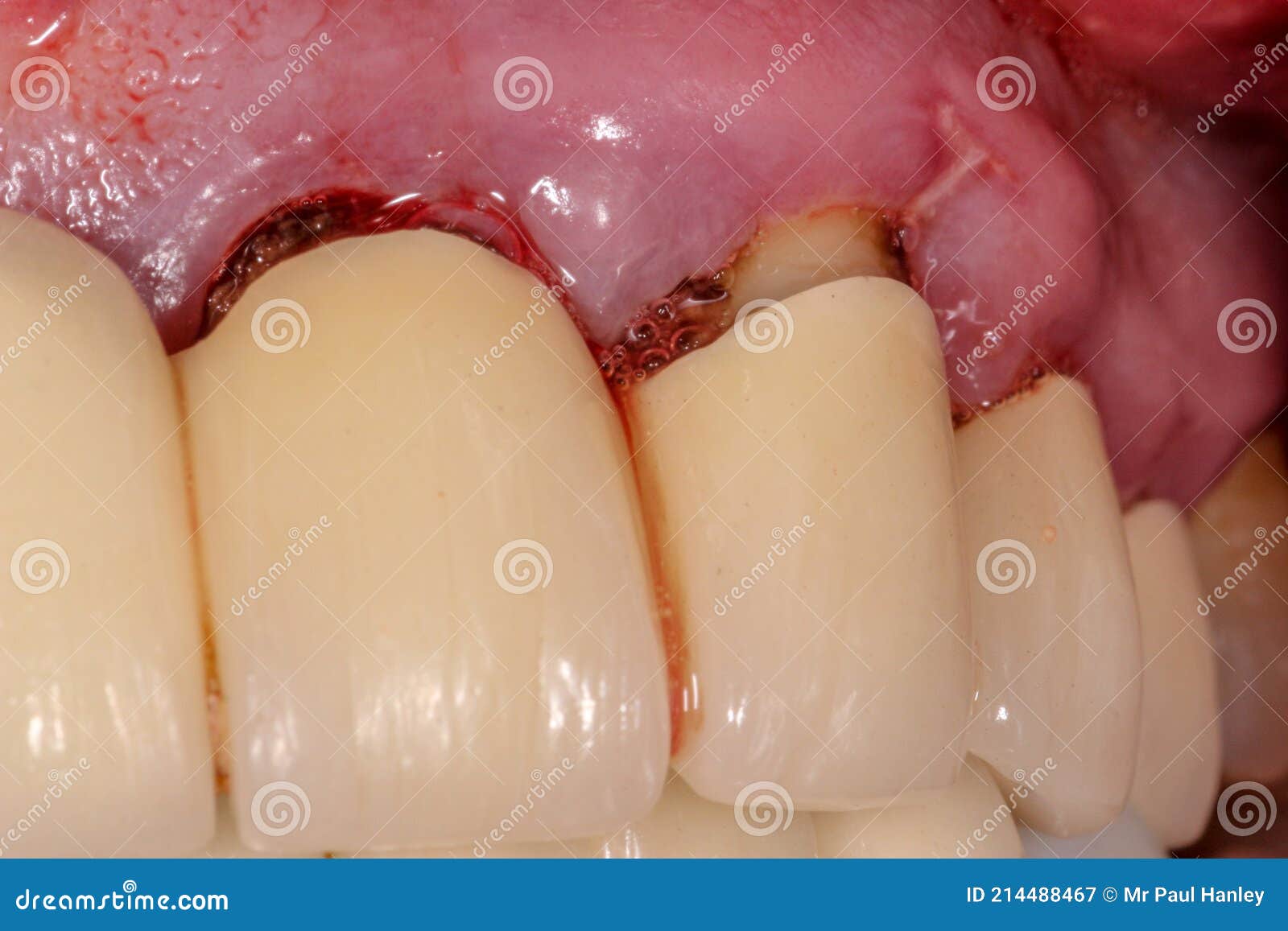 A Very Bad Case of Periodontitis Stock Image Image of gums, abscess