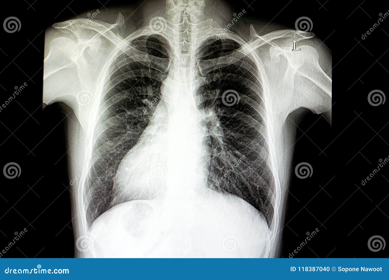 A Patient With Situs Inversus Stock Photo - Image of contrast, heart