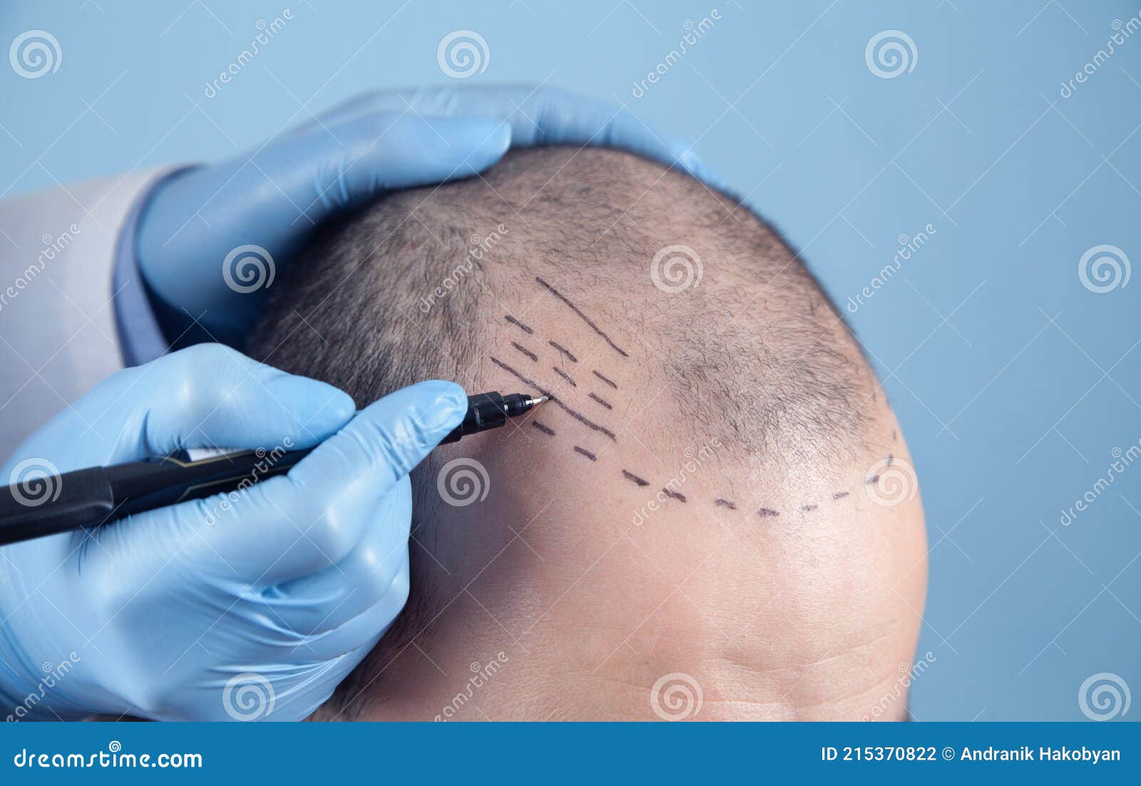 hair loss doctor near me