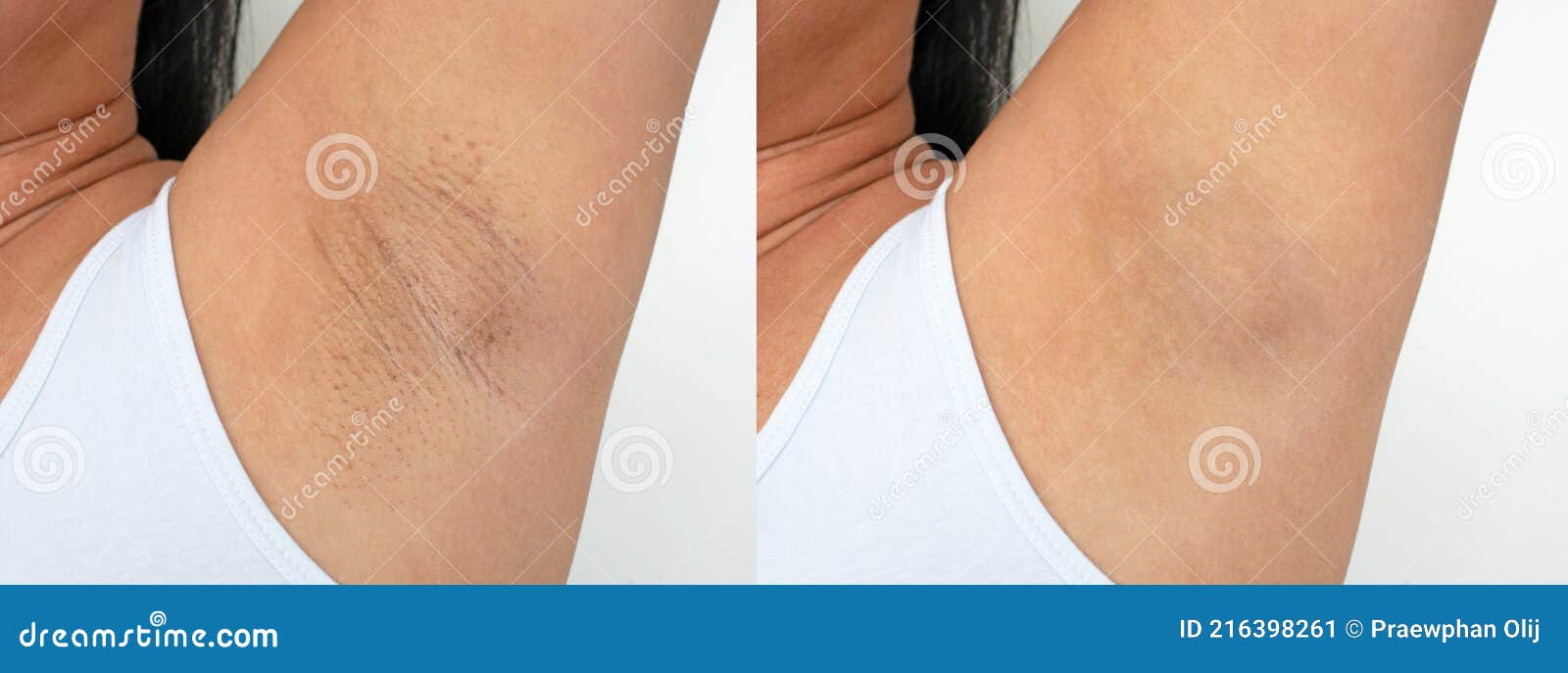 Peau D'aisselle Noire En Femme Asiatique. Problème Peau De Poulet Rugueuse.  Image Avant Et Après Soins Cosmétiques Aisselles Epila Image stock - Image  du concept, poulet: 216398261