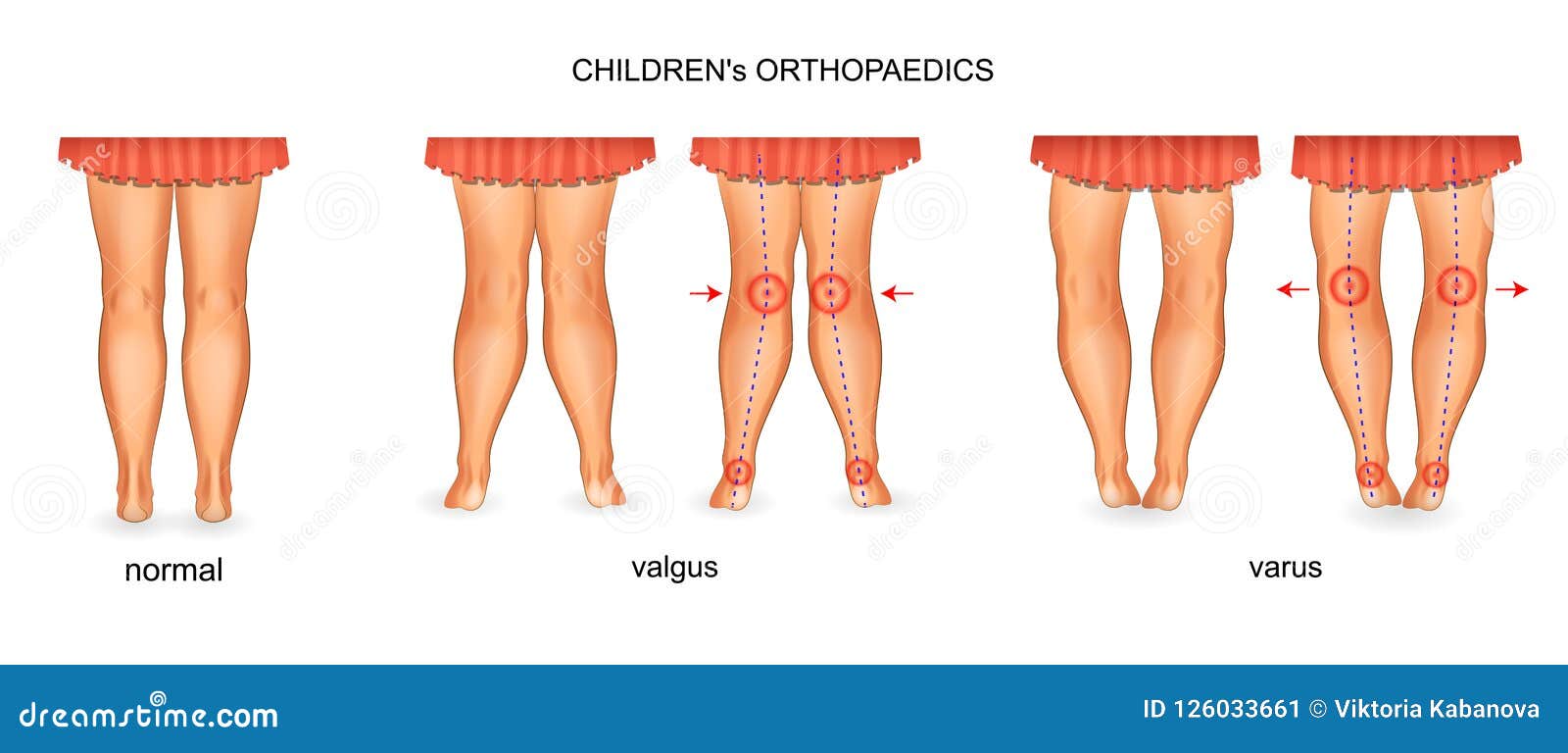 pediatric orthopedics. valgus and varus