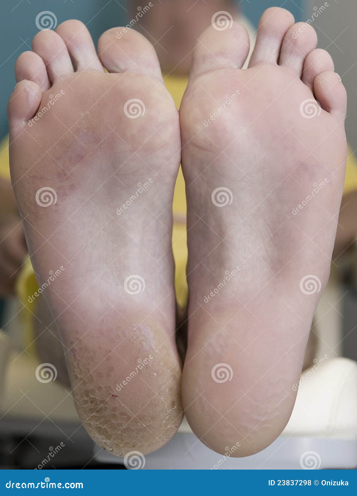 Pedicure before after stock photo. Image of skin, healthy 23837298
