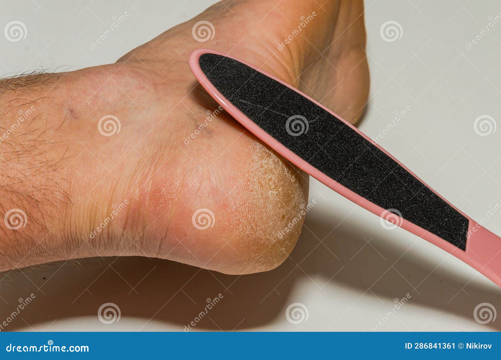 Pedicure File Does a Pedicure on a Cracked Heel Stock Image Image of