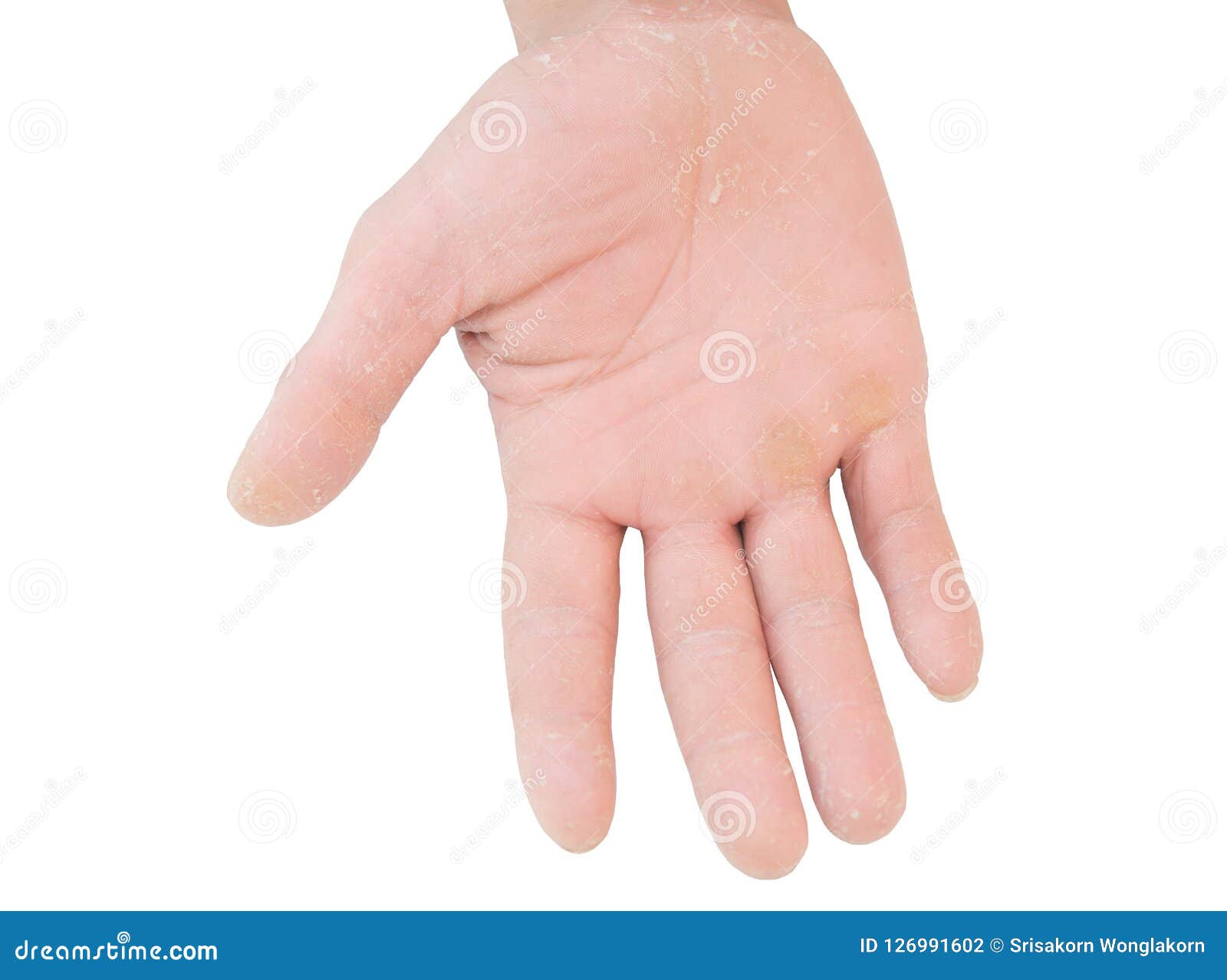 Peel the Skin from Allergies Stock Photo Image of peel, eczema 126991602