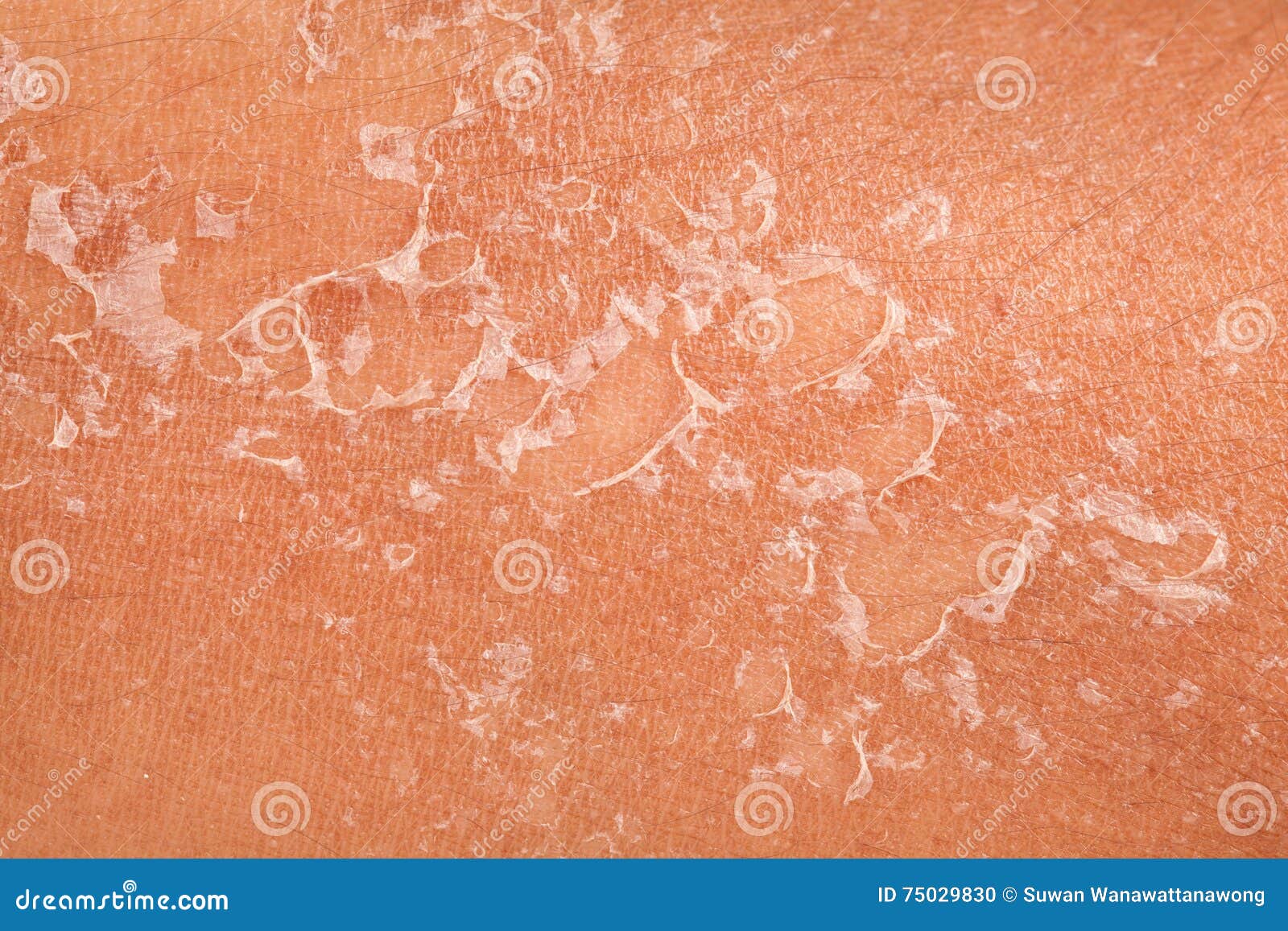 Peeling of Skin after Burned by Sunlight Stock Photo Image of illness